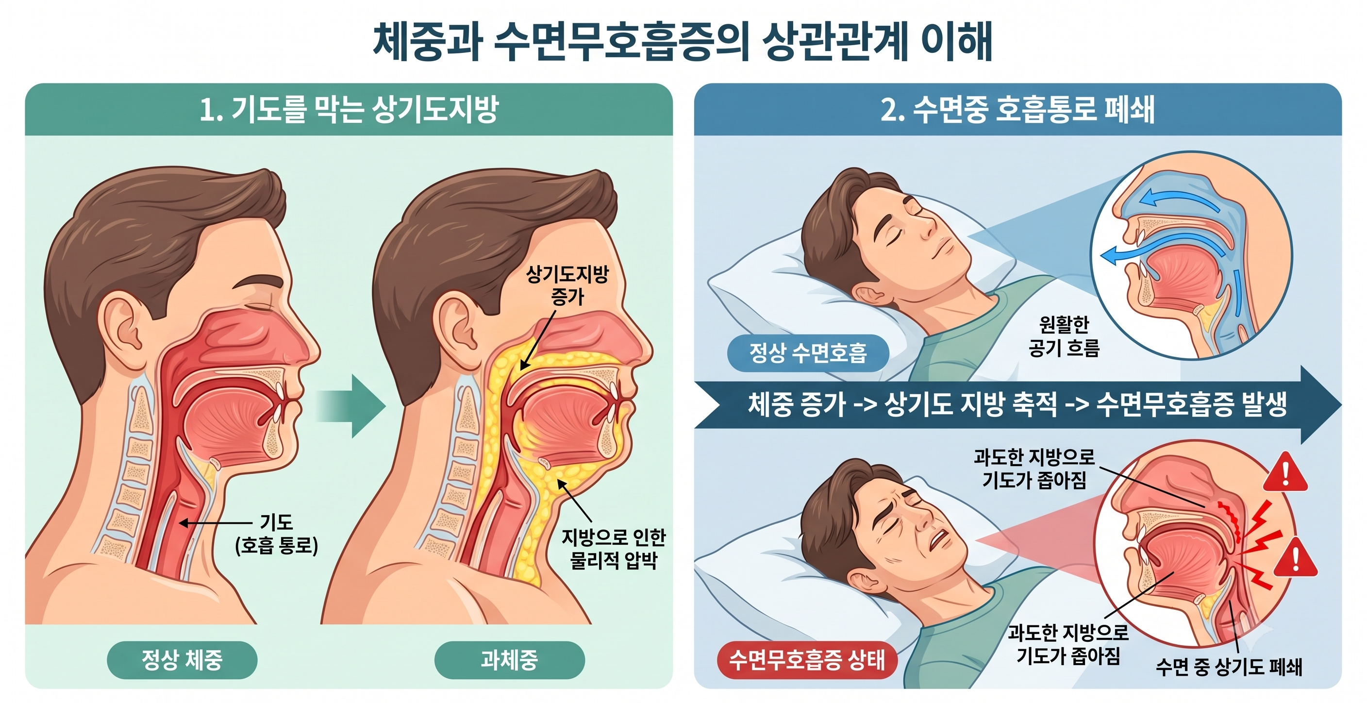 "살 빼는 주사가 코골이도 고친다?" 최근 승인된 비만 치료제의 수면무호흡증 개선 효과와 정밀 수면다원검사