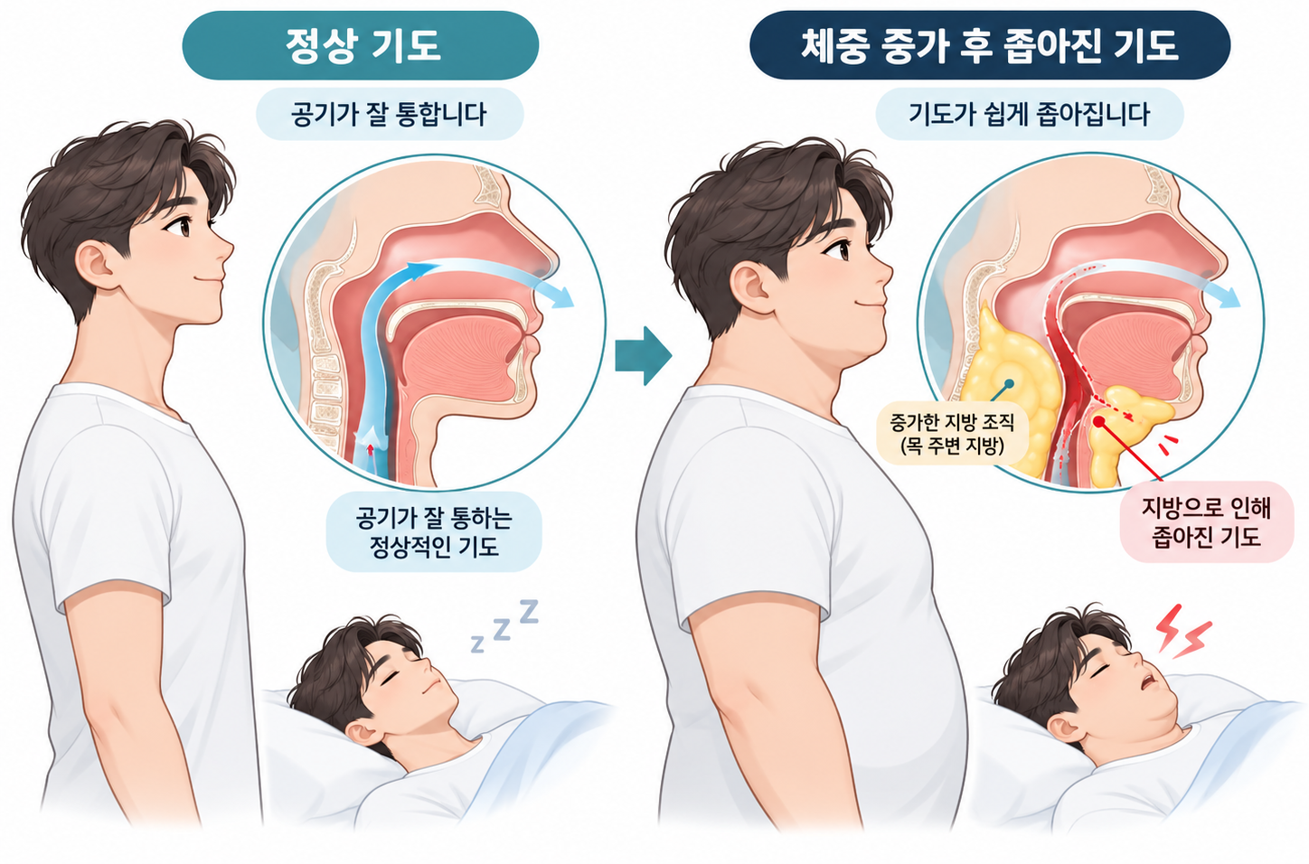 살찌고 코골이가 심해졌다면? - 비만 수면무호흡증 검사와 체중감량 치료
